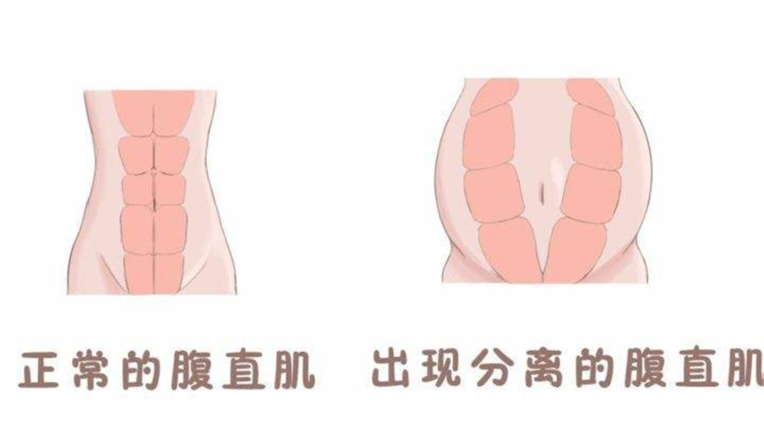 腰痛是产后妈妈难逃的劫，与麻药无关也非月子病，怀孕时就已注定