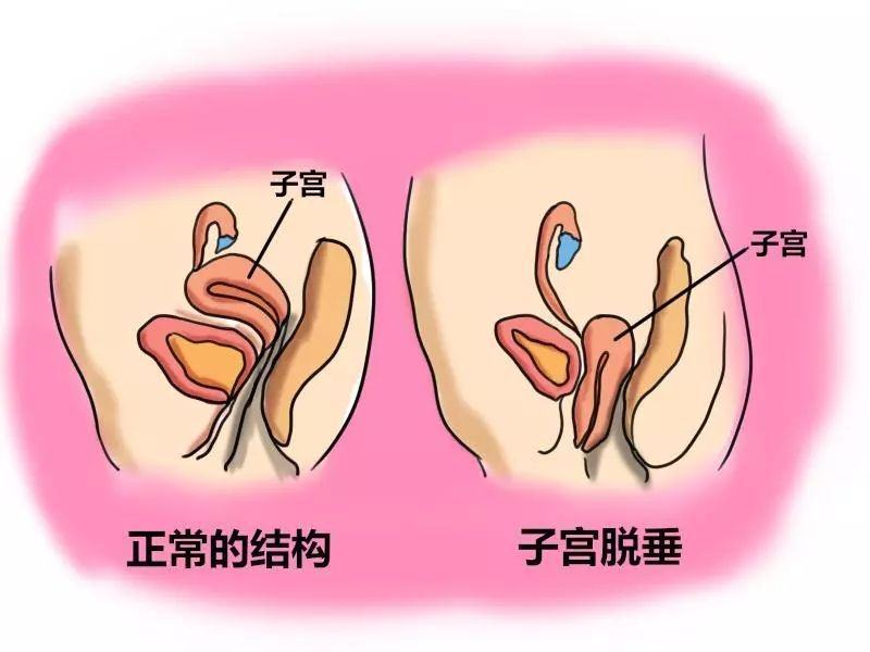 子宫脱垂到底是什么？