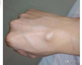 腱鞘囊肿针刺治疗方法详解