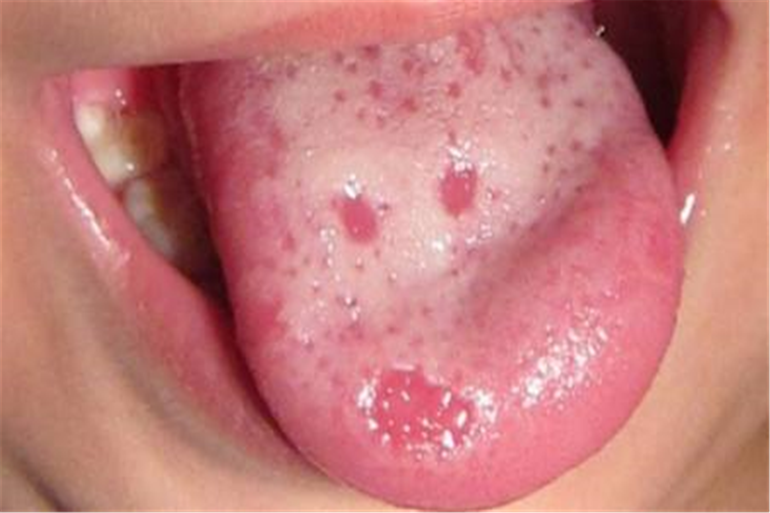 舌头缺锌什么症状图片图片