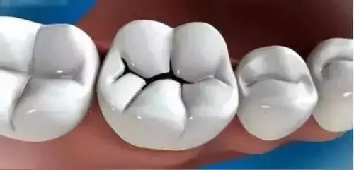 “酸倒牙”是怎么回事?能自行治好吗?