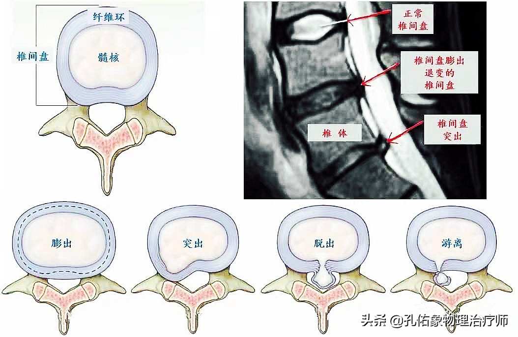 同样是腰椎间盘突出，为什么有人痛不欲生，有人却安然无恙？