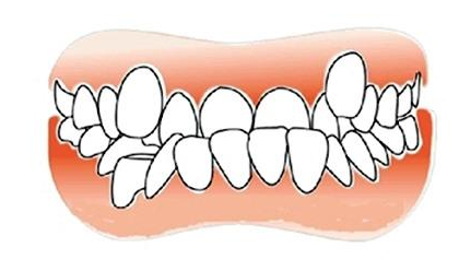 "地包天"不仅影响咬合还影响面容，该怎么矫正？听听牙医的建议
