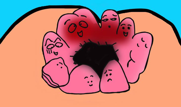 其实,痔疮只是一个统称,根据生长部位的不同,可以把痔疮分为内痔,外痔