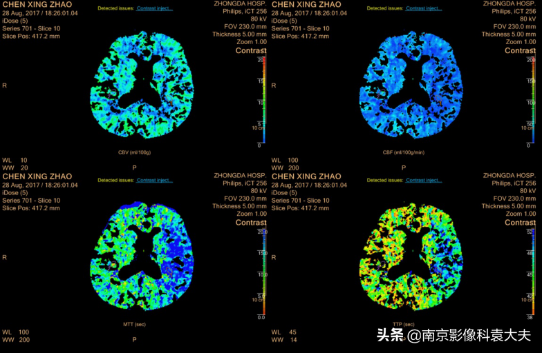 中国脑血管病影像指导手册解读（19年5月版）之急性缺血卒中评估