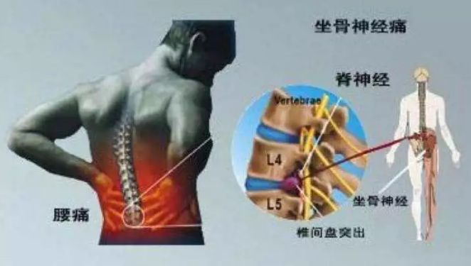 坐骨神经痛有什么特点？需要怎样治疗呢？