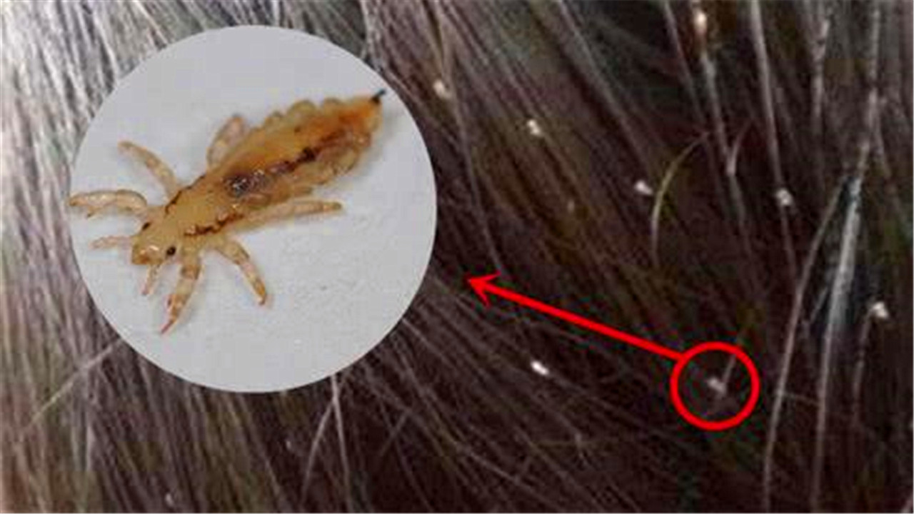 虱子与人类共同进化的起源历程
