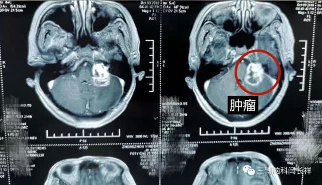 厦门一男子拔牙6颗，牙痛依旧，一查竟是“天下第一痛”惹的祸