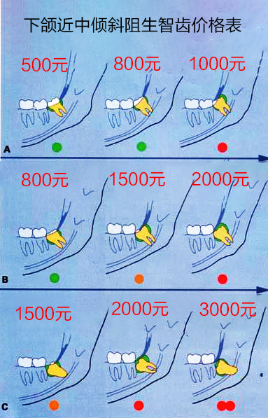 智齿拔除多少钱一颗图片