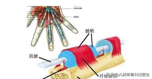 都是腱鞘炎，为啥我家宝宝是先天性的？家长想知道的都在这里