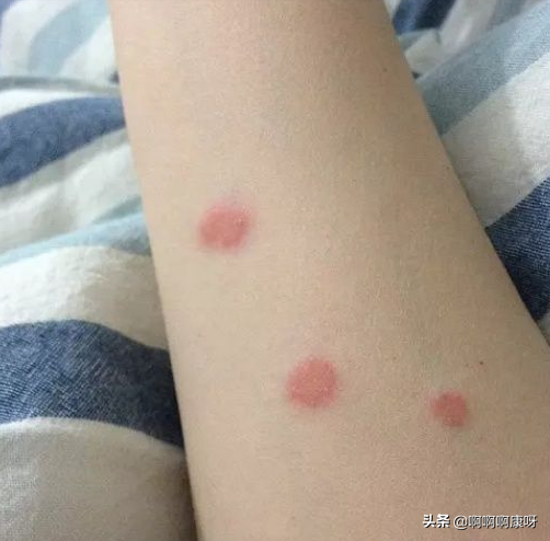 怎么判断感染猫藓，猫藓又是什么，猫藓患者教你预防治疗的好办法