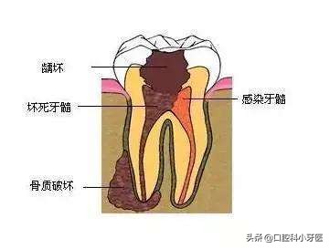 牙齿疼痛难忍口腔医生诊断牙髓炎，牙髓炎症可以消炎治疗吗？