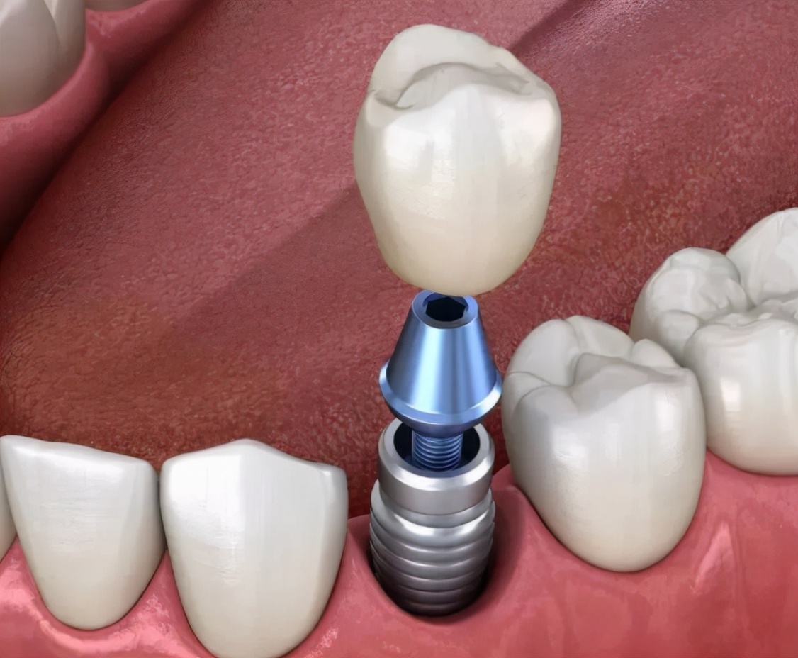 老年人年纪大了,做种植牙究竟值不值得?