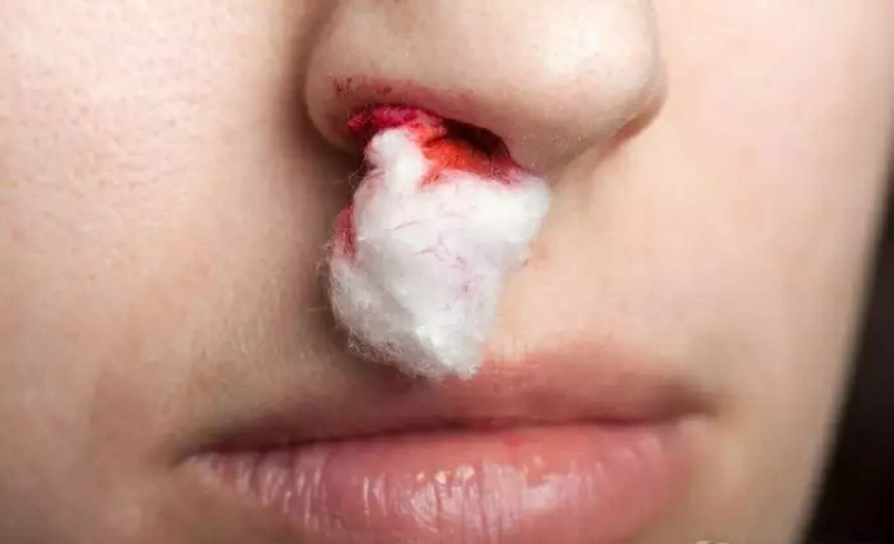 流鼻血不一定是上火,还有可能是这些健康隐患