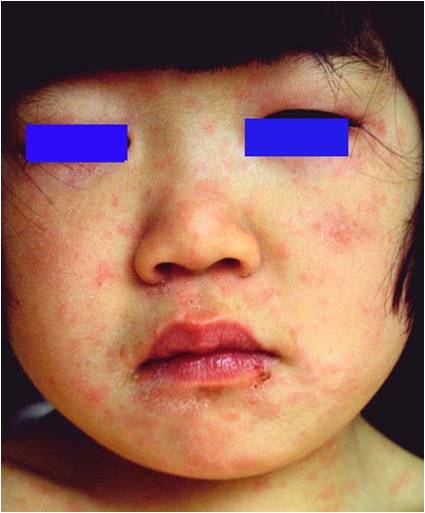 热疹子是什么症状图片(伴有发热的皮肤病) - 赤虎壹号