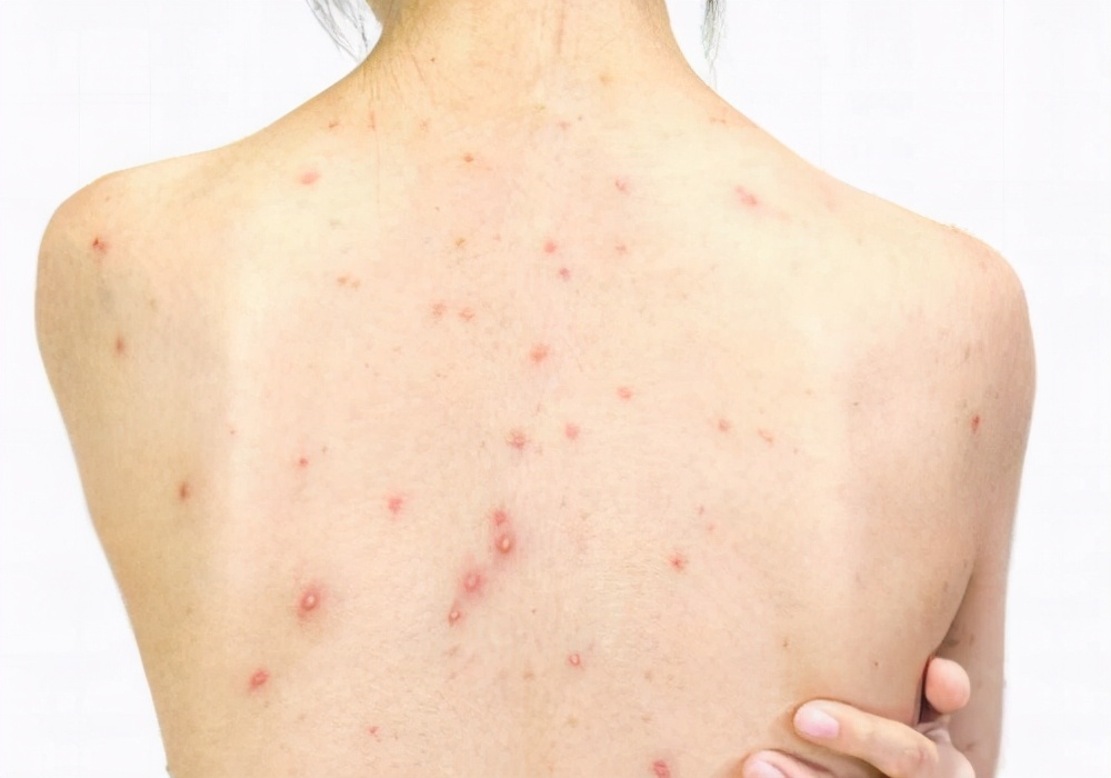 后背长痘太烦恼,这三种常见的治疗误区,你中招了吗?