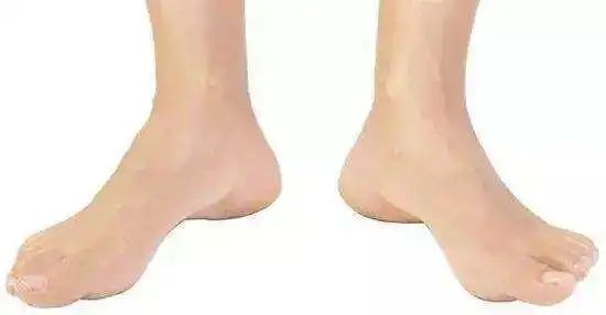 走路外八需要怎样纠正?