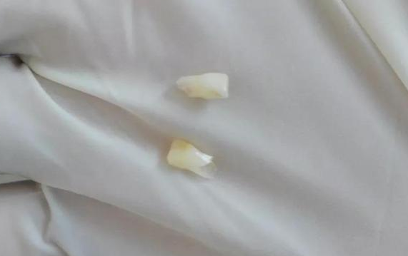 孩子的乳牙储存起来别扔，关键时候能救命？有条件没想的那么简单