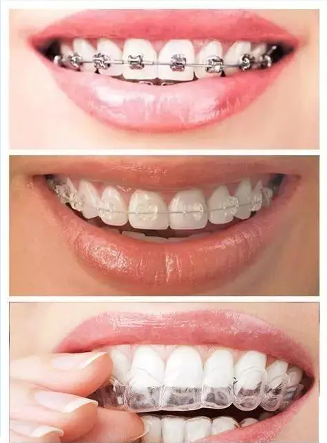 纠正牙齿一般多少钱(牙齿矫正) - 价格百科