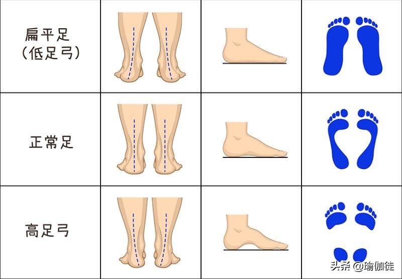 婴儿足弓反张图片（什么是扁平足）