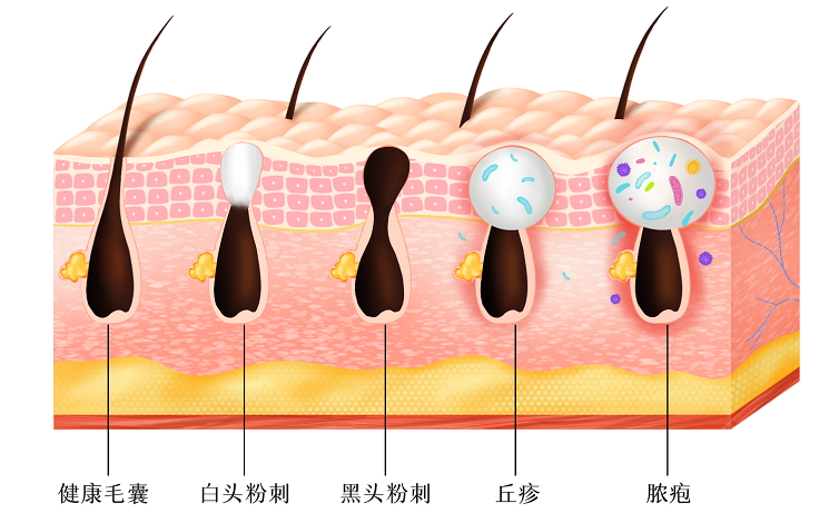 如何调理痘痘粉刺？教你3个食疗方