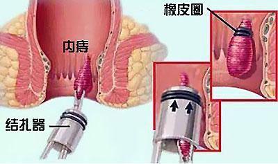 什么痔疮需要手术？有哪些治疗手段？一次性全都告诉你