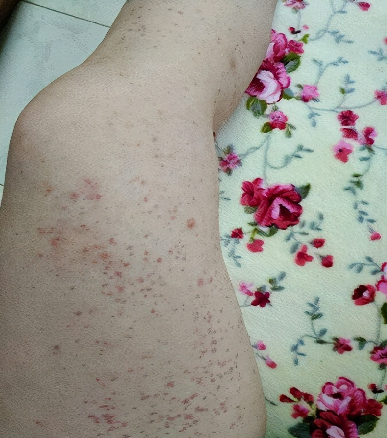 身上长了小红点,是肝病的表现吗?3个潜藏病因,了解一下