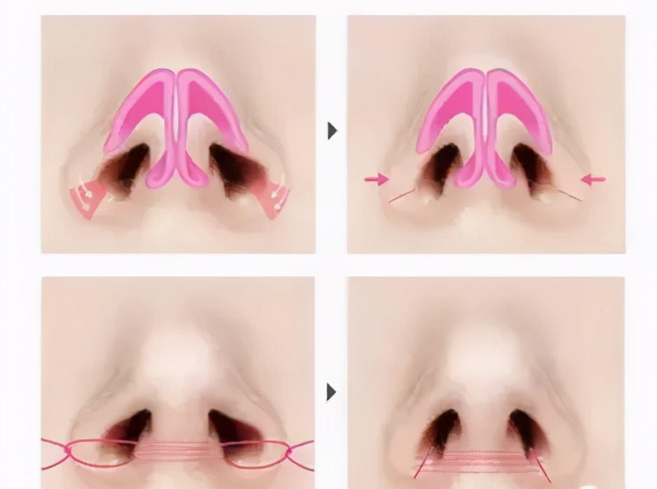 鼻部手术中，如何改善鼻孔的美观程度