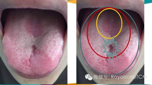 舌頭根部長肉顆粒圖片(手把手教您望舌識病情) - 赤虎壹號