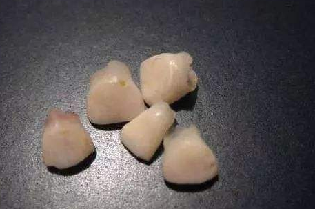 孩子的乳牙储存起来别扔，关键时候能救命？有条件没想的那么简单