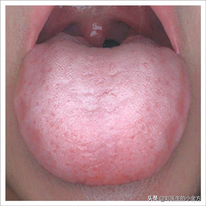淡紫胖嫩舌淡胖齿痕舌淡白舌薄润苔
