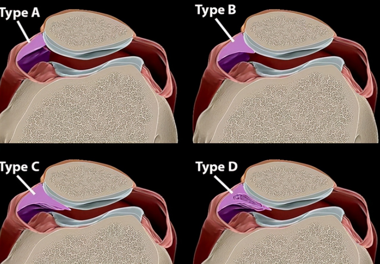 走路时，膝盖突然“软”一下，是咋回事？医生告诉你真相，要留心