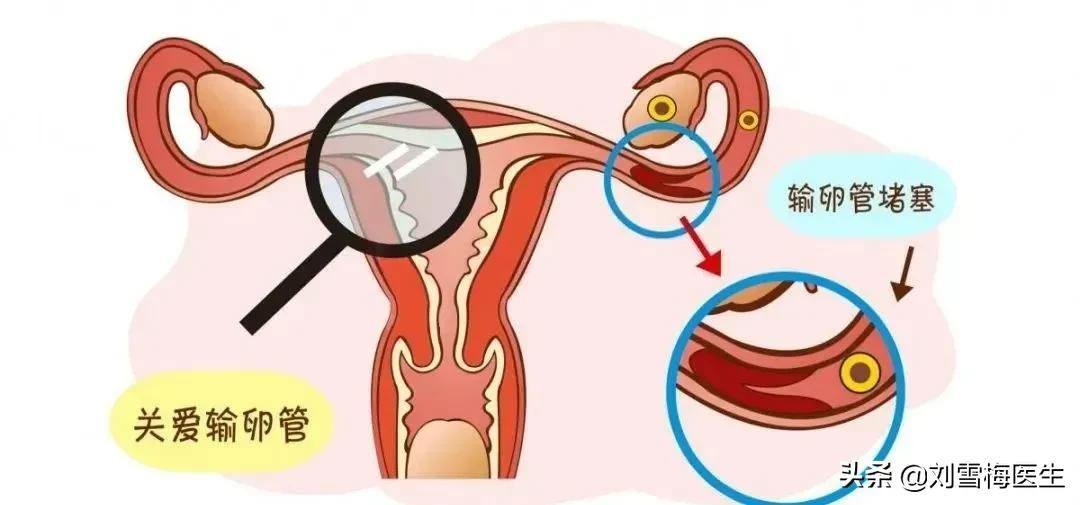 输卵管造影疼吗？做完多久可以要孩子？你想问的这里都有答案