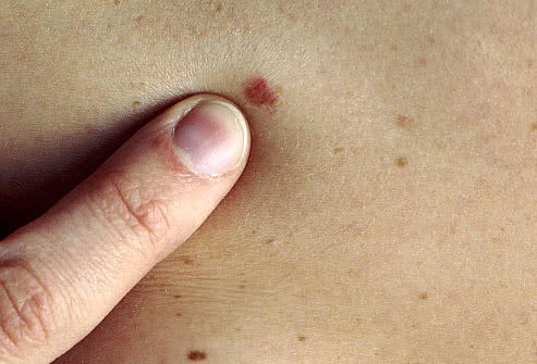 皮肤癌:不论男女,痣出现这5种变化,小心它正在"癌变"