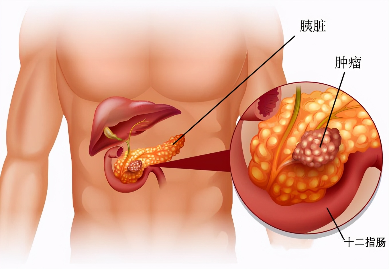 上腹痛以为是胃病，结果是胰腺癌，它们两有区别，记住四大症状