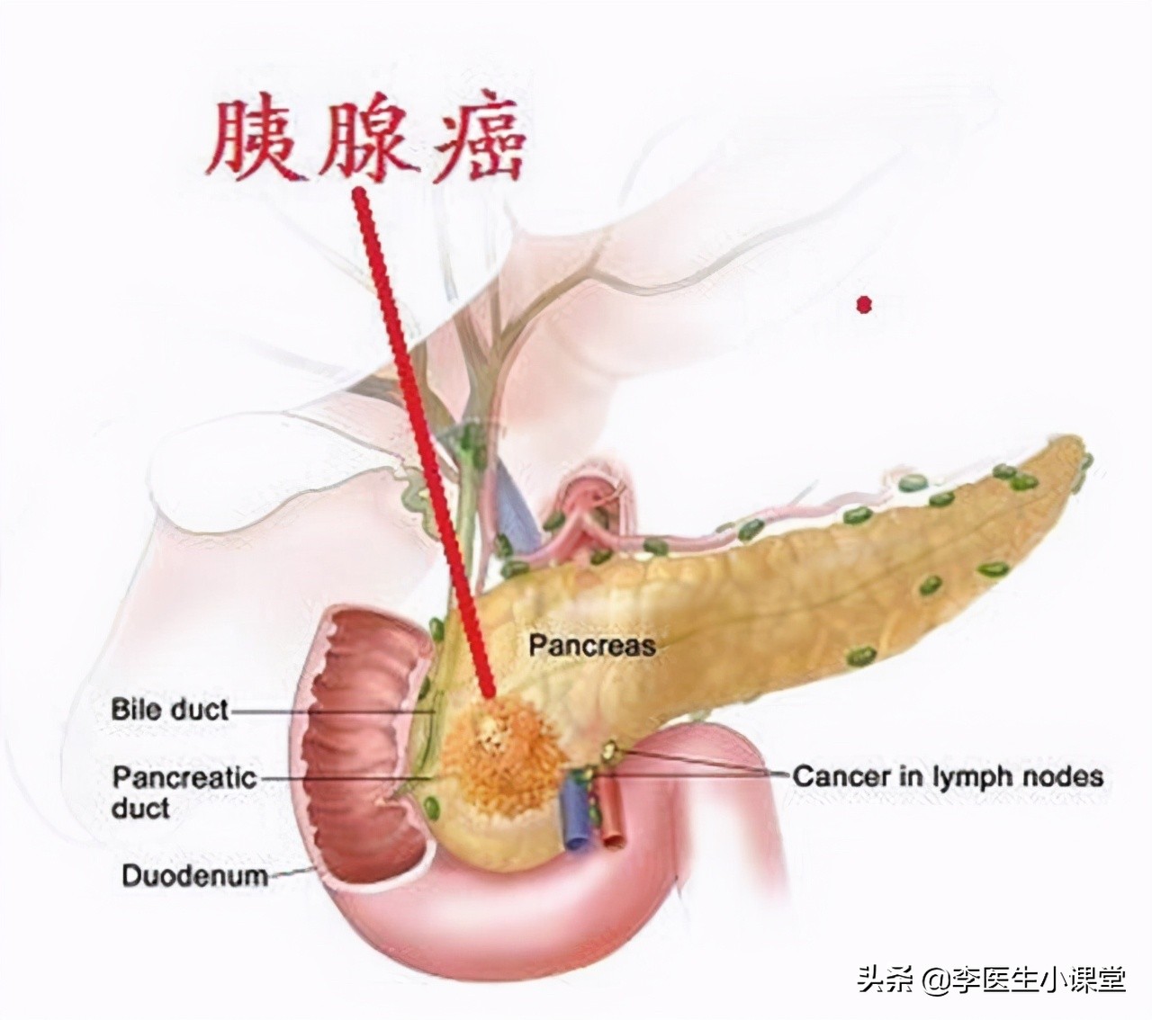 做彩超和增强CT都怀疑胰腺癌，做核磁没发现病灶，听医生怎么说