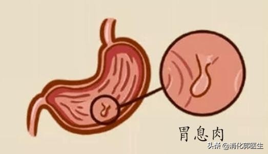 胃息肉反复发作原因及有效消除方法
