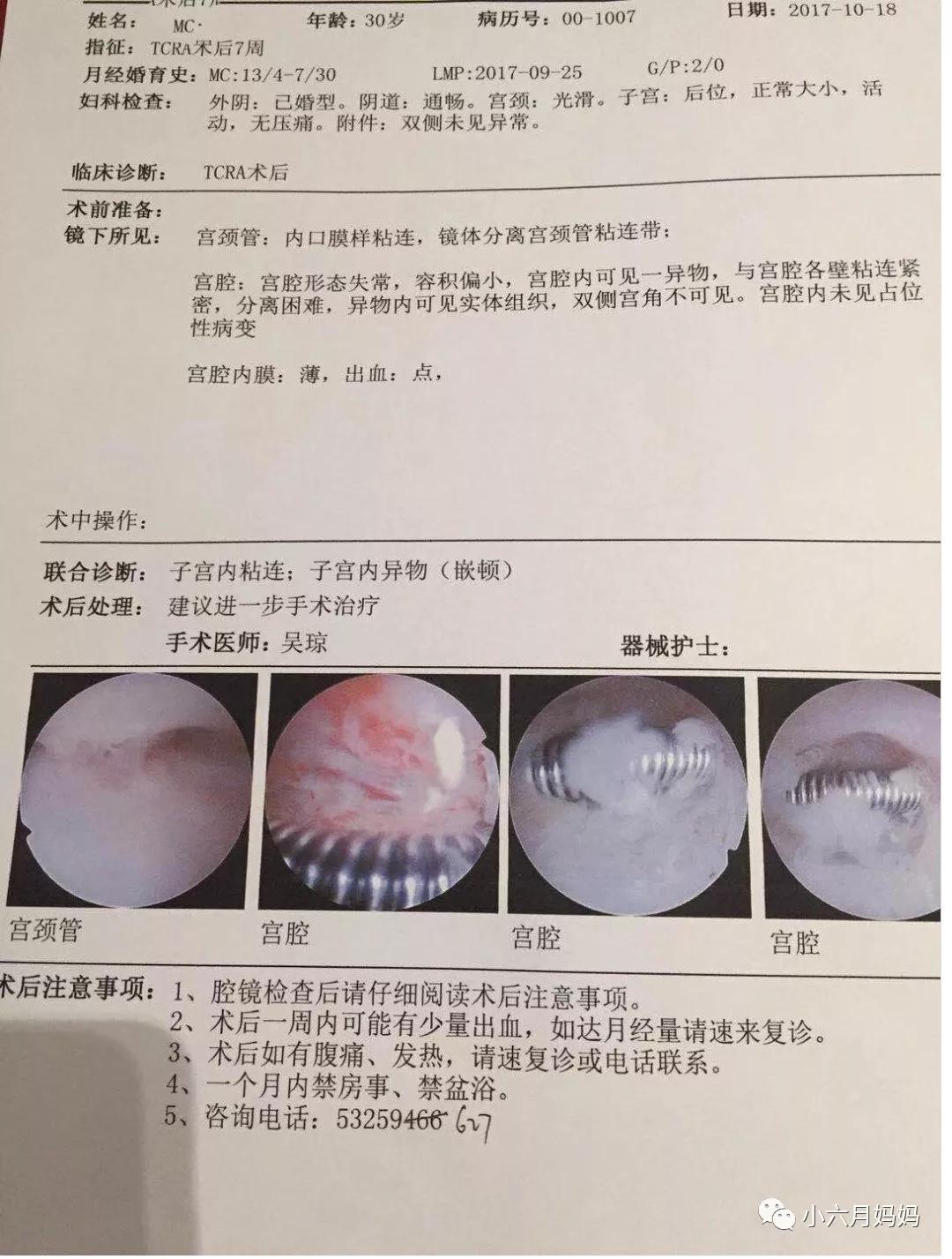 宫腔粘连你是否还在走弯路（下）