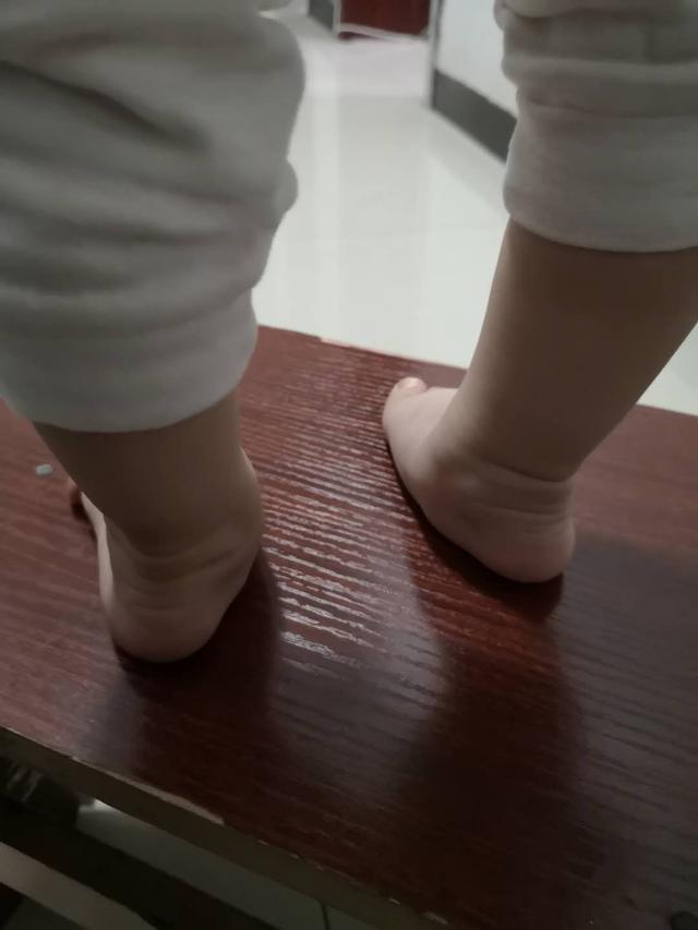 什么是足外翻?需要治疗吗?