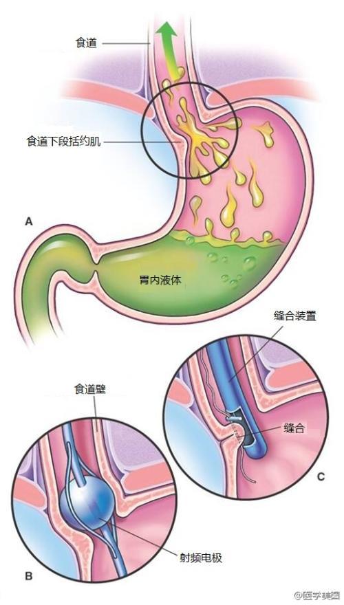 胃食管反流病怎么治