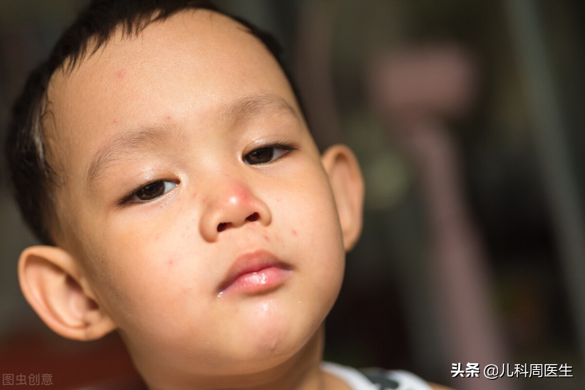 来给春季传染病“点点名”，不仅有幼儿急疹、手足口病还有腮腺炎