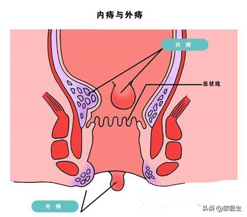 肛门囊肿什么症状图片(因为痔疮就诊) - 赤虎壹号