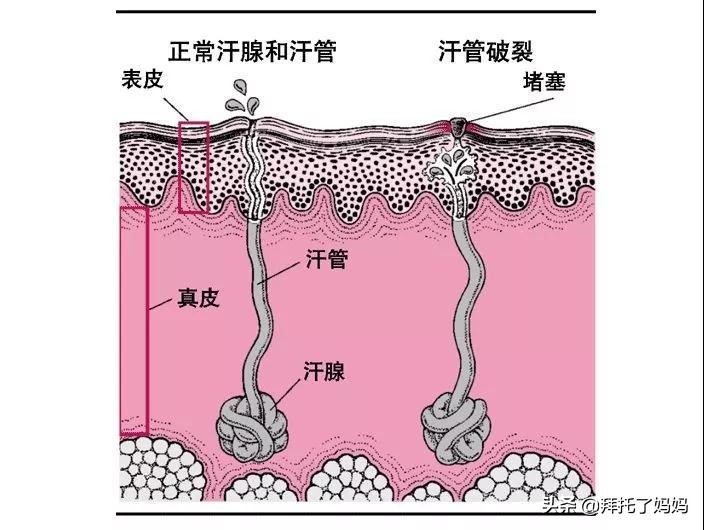 水晶痱、红痱、脓痱，不同痱子护理方法大不同，妈妈要学会分辨