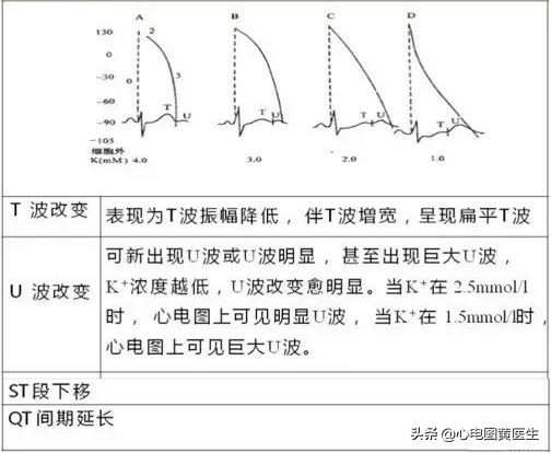 高钾血症与低钾血症心电图表现总结