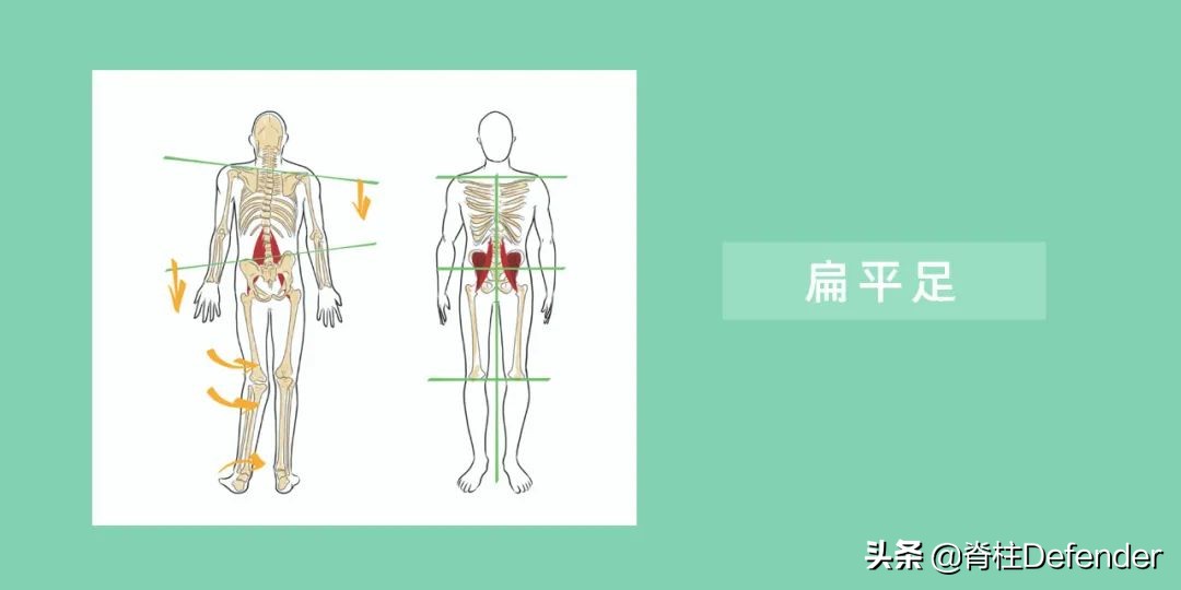 高低肩，怎样科学矫正？