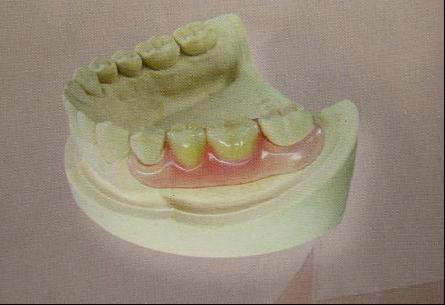 各类假牙汇总，最贵的假牙价值近百万