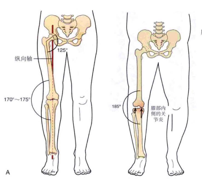 nba有哪些o型腿(詹姆斯也是O型腿，为什么他膝关节不疼，而我打篮球就腿痛呢？)