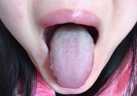 舌头有裂纹说明什么？是肾阴虚？是脾阳虚？1个办法，关键是对症