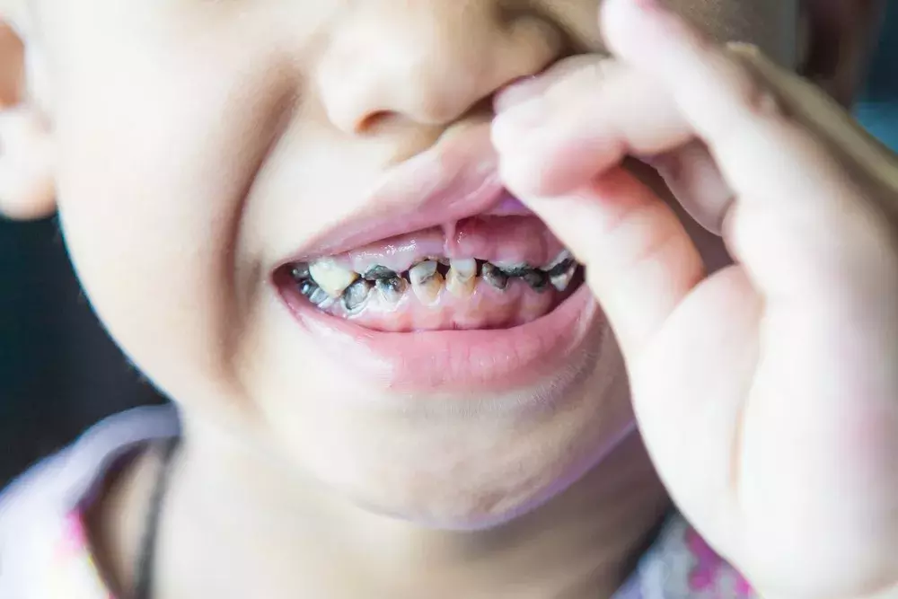 涂氟能预防蛀牙!孩子多大能涂?多长时间涂一次?需要注意啥?