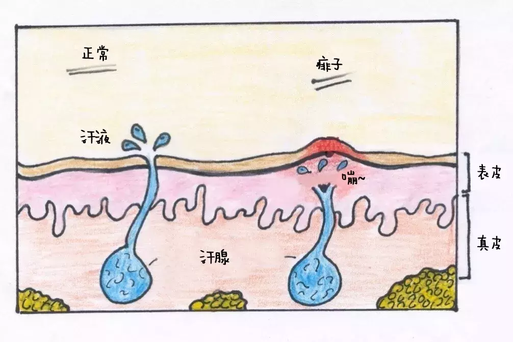 孩子天热起痱子，学会这几招轻松应对！